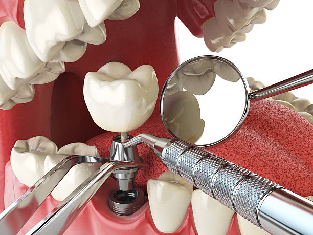 Best Emergency Denture Repair in South Gull Lake, MI
